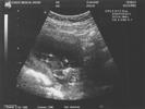 Second Ultrasound